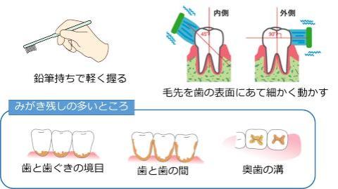磨き残しの多いところは、歯と歯茎の境目、歯と歯の間、奥歯の溝です