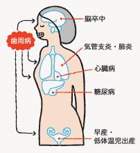 歯周病と全身疾患のイラスト